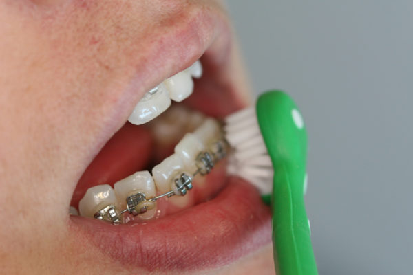 Surround_Toothbrush_brushing_over_around_braces_green